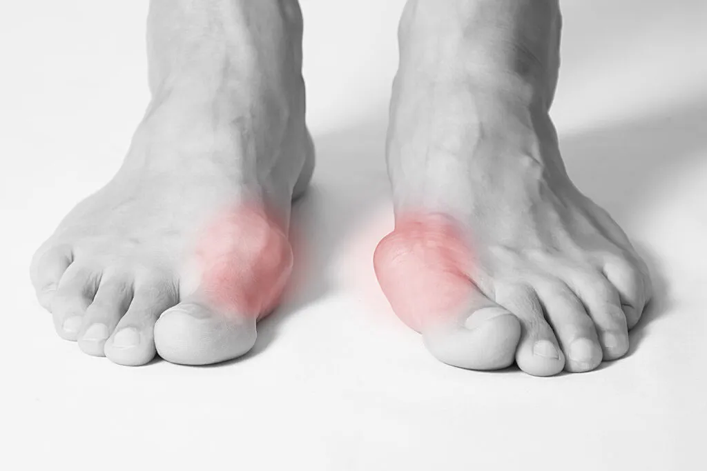 bunion 1024x683